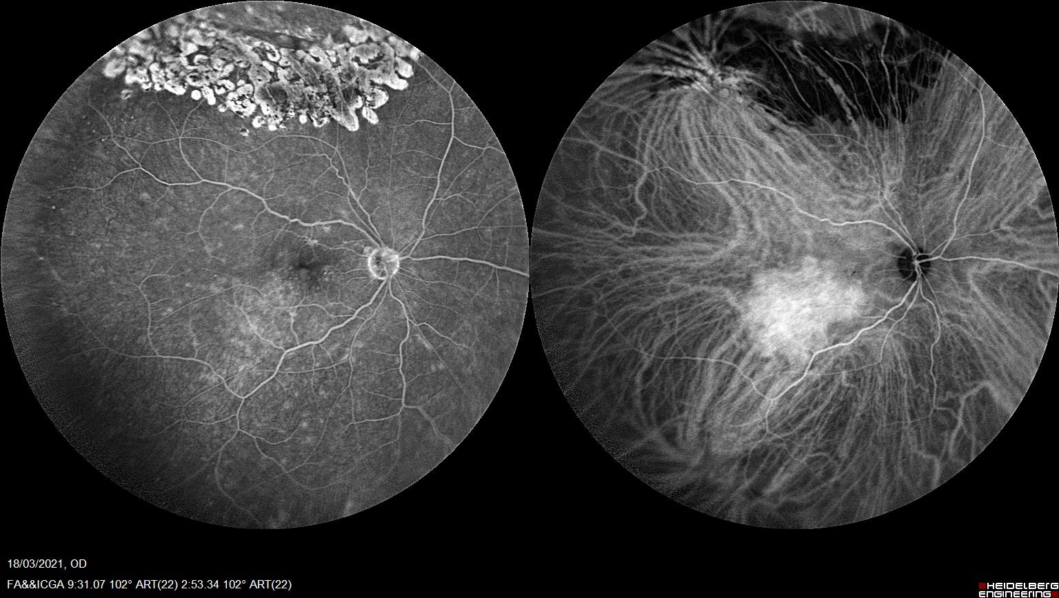 Angiografia fluoresceínica (Imagen de la izquierda) y verde de indocianina (imagen de la derecha) simultáneas en hemangioma coroideo