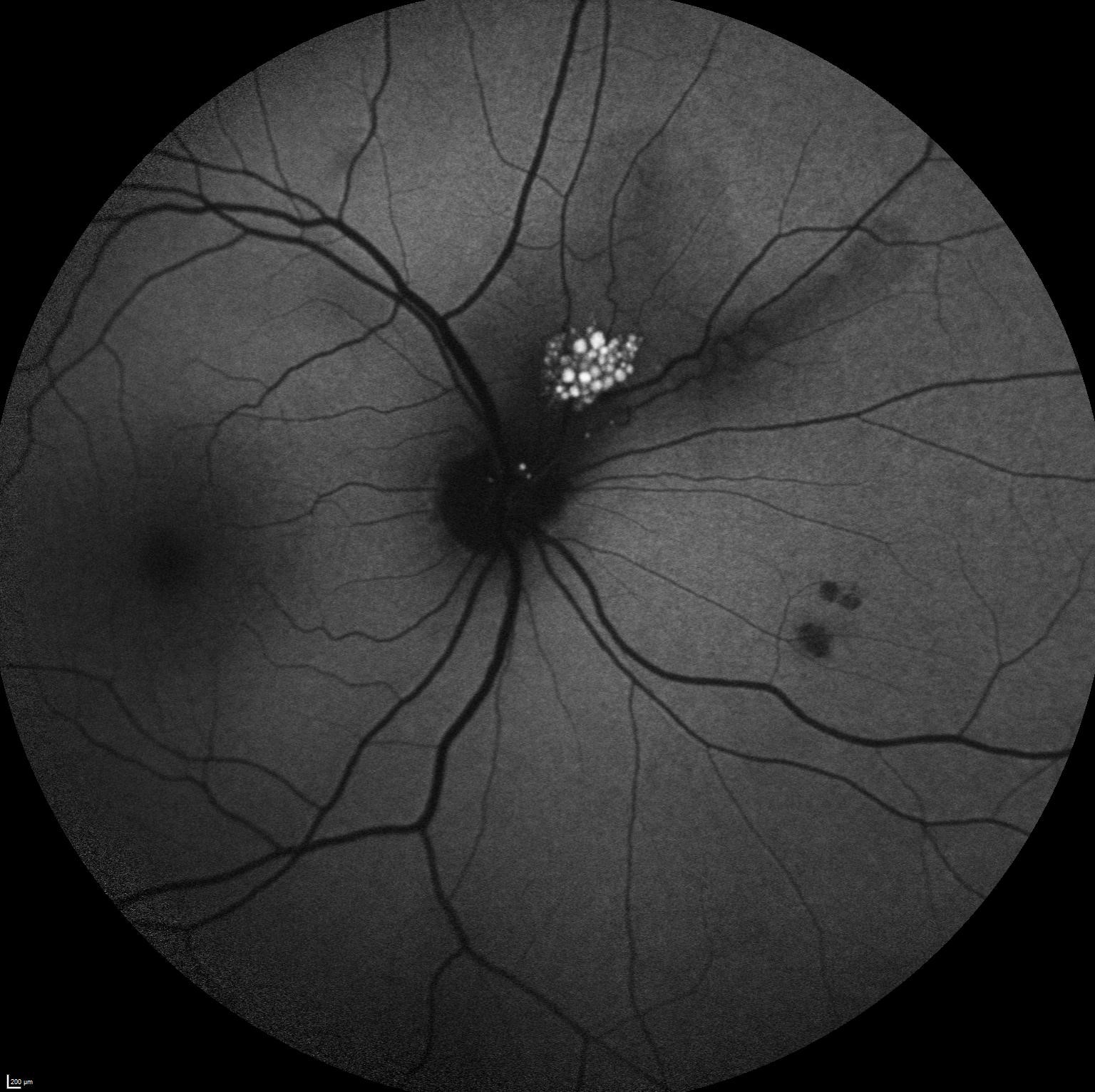 Autofluorescencia en astrocitoma