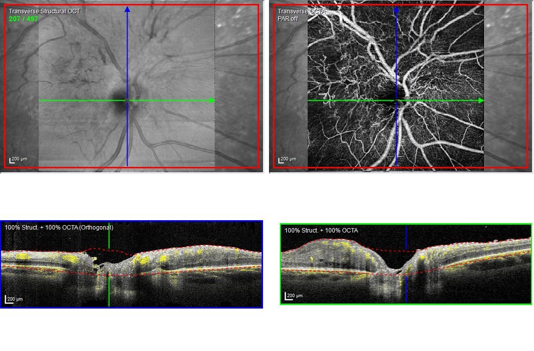 Hamartoma combinado de retina y EPR